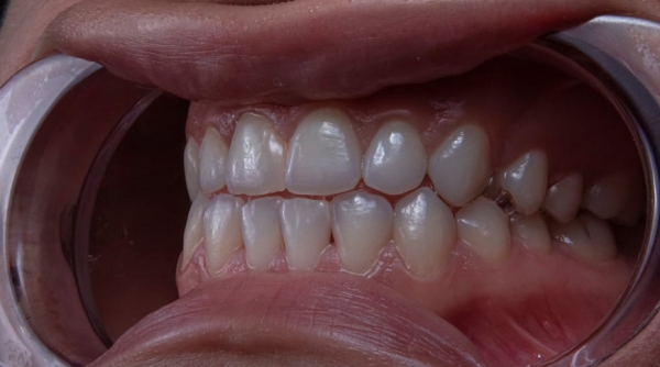  Человеческие зубы впервые вырастили в лабораторных условиях