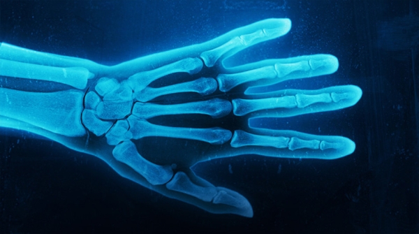 Гонконгские ученые создали ИИ, генерирующий 3D-модели костей по рентгеновским снимкам